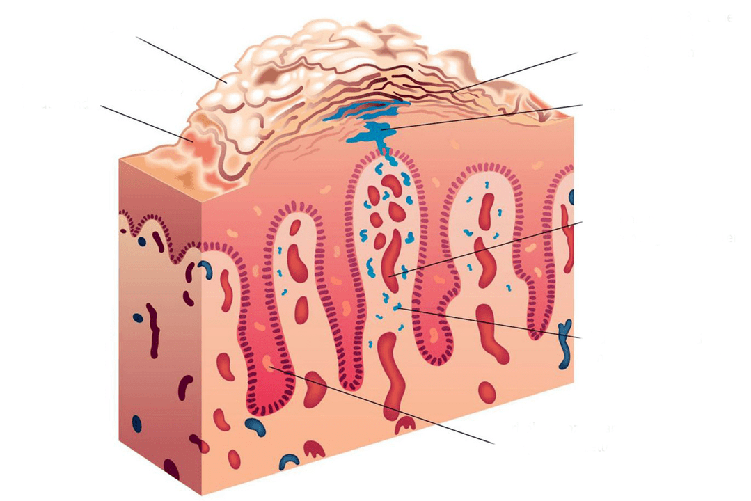 sezione trasversale della pelle nella psoriasi