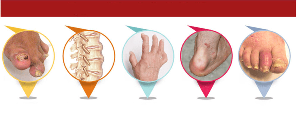 tipi di artrite psoriasica