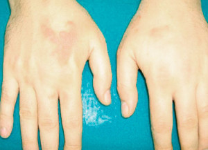 La localizzazione della malattia sulle mani