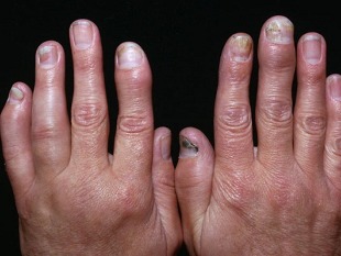 la psoriasi artrite