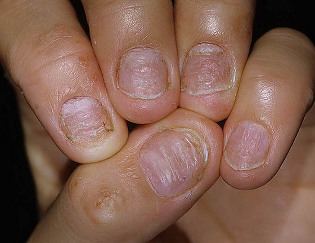 psoriasi delle unghie